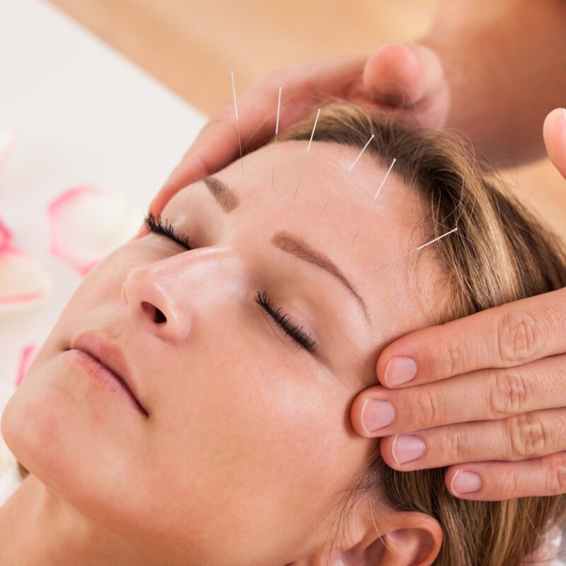 Acupuncture-Face-Lift